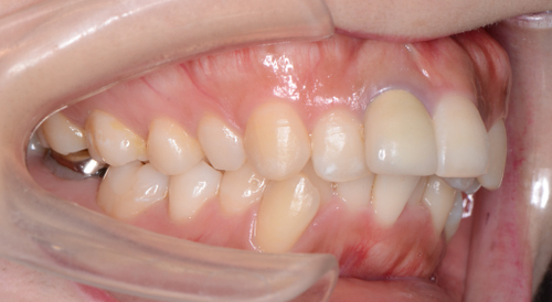 治療例007 - 左横から見た治療前の歯並び