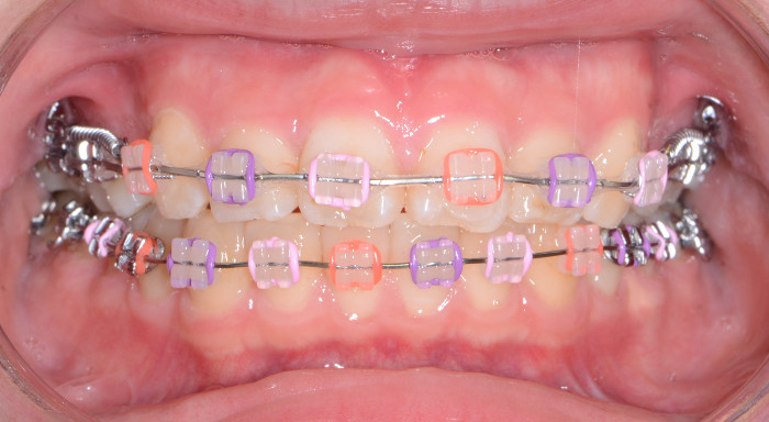 治療例008 - 正面から見た治療中の歯並び