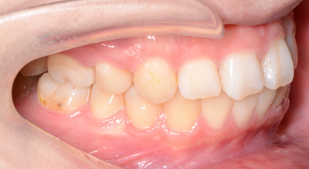 治療例008 - 左横から見た治療後の歯並び