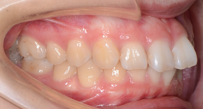 治療例008 - 左横から見た治療前の歯並び