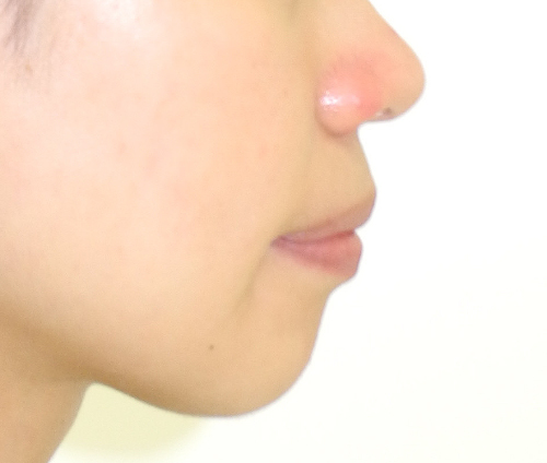 治療例009 - 左から見た治療後の横顔