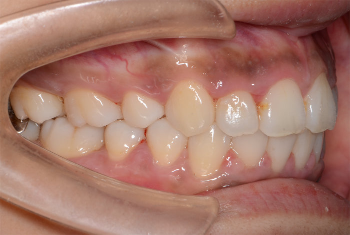 治療例009 - 左横から見た治療後の歯並び