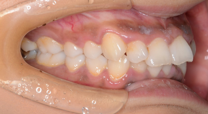 治療例009 - 左横から見た治療前の歯並び