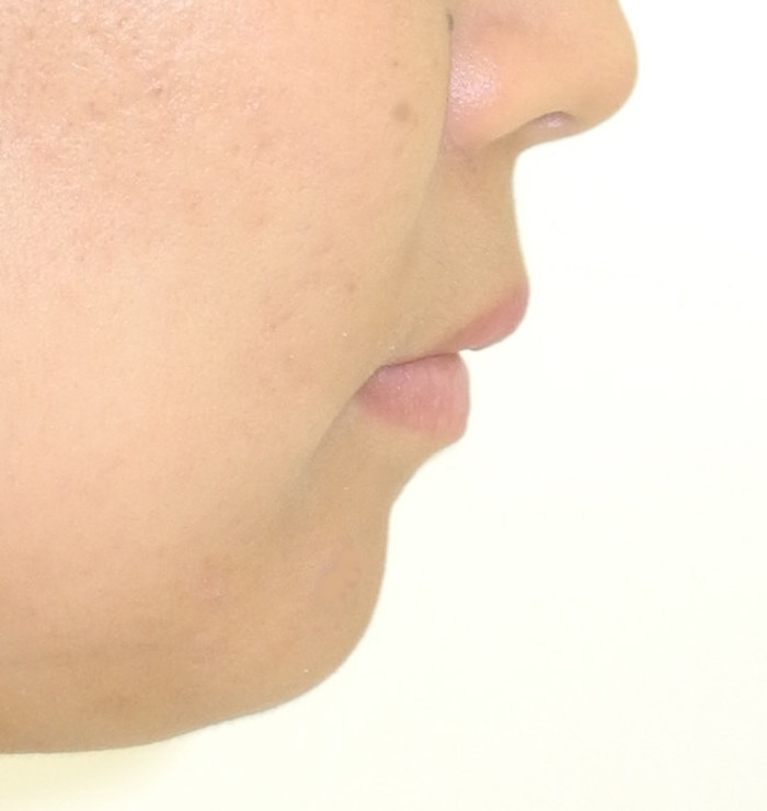 治療例008 - 左から見た治療後の横顔