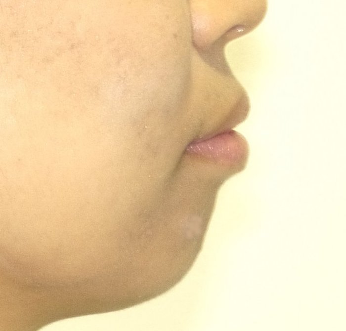 治療例008 - 左から見た治療前の横顔