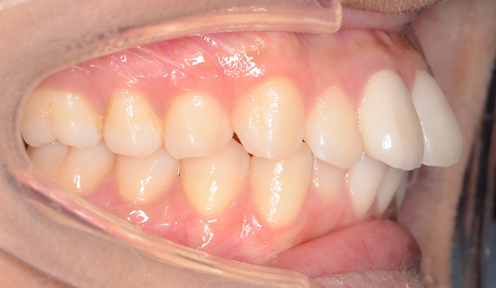 治療例008 - 左横から見た治療前の歯並び