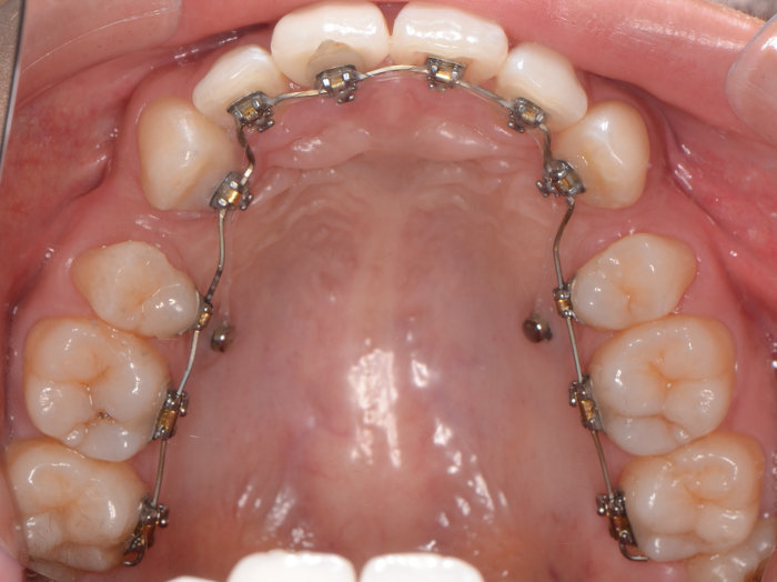 治療例008 - 下から見た治療中の歯並び