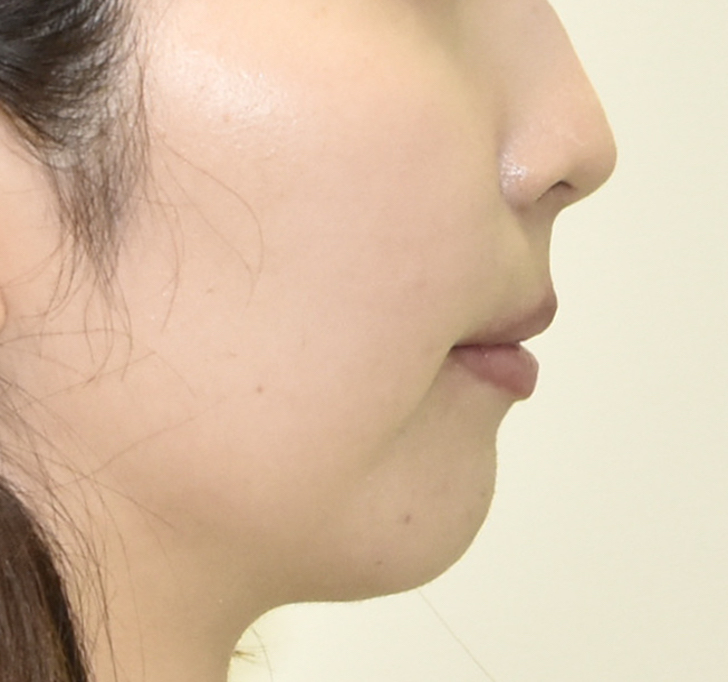 治療例010 - 左から見た治療後の横顔