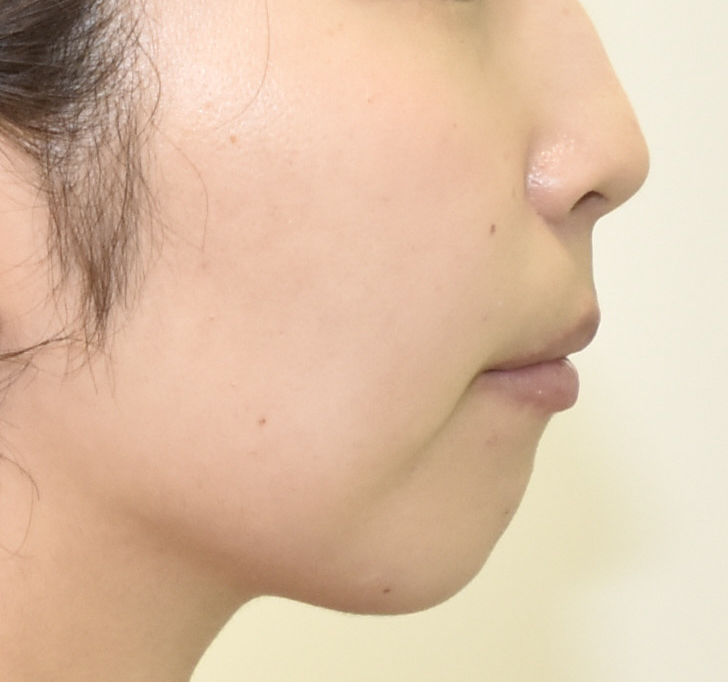 治療例010 - 左から見た治療前の横顔