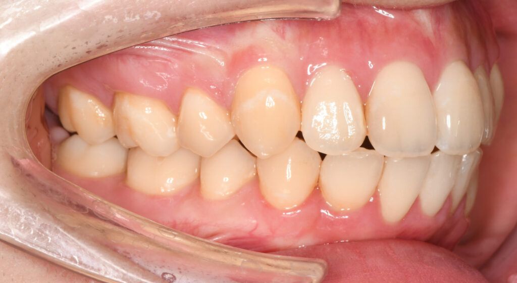 治療例010 - 左横から見た治療後の歯並び