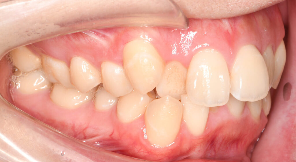 治療例010 - 左横から見た治療前の歯並び