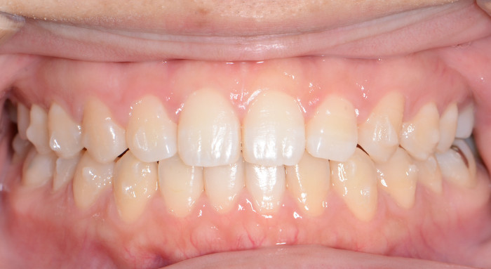 治療例012 - 正面から見た治療後の歯並び