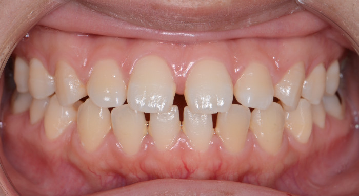 治療例012 - 正面から見た治療前の歯並び