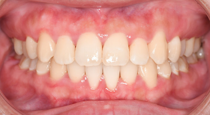治療例013 - 正面から見た治療後の歯並び