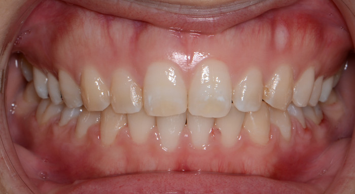 治療例014 - 正面から見た治療後の歯並び