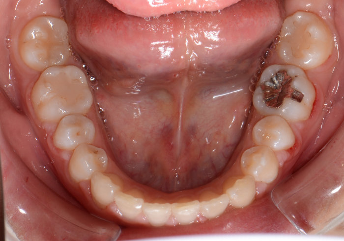 治療例014 - 下から見た治療後の歯並び