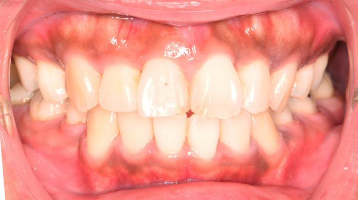 治療例015 - 正面から見た治療後の歯並び