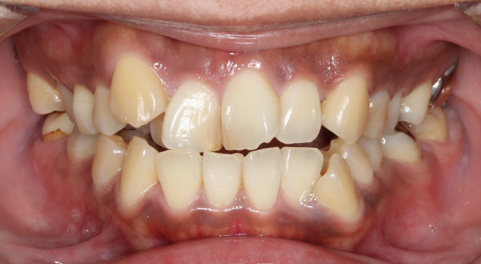 治療例015 - 正面から見た治療前の歯並び
