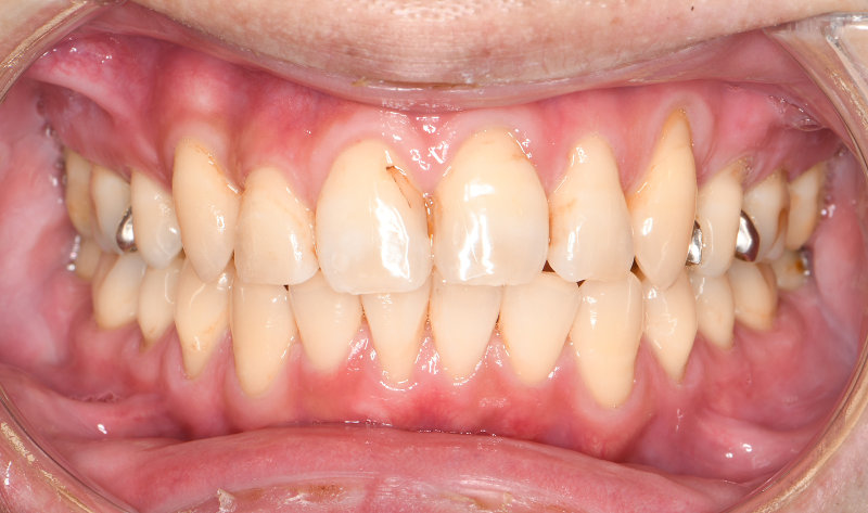 治療例016 - 正面から見た治療後の歯並び