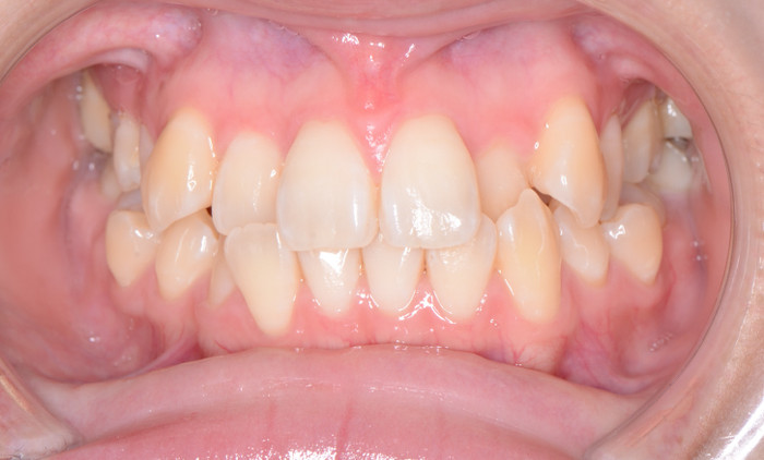 治療例016 - 正面から見た治療前の歯並び
