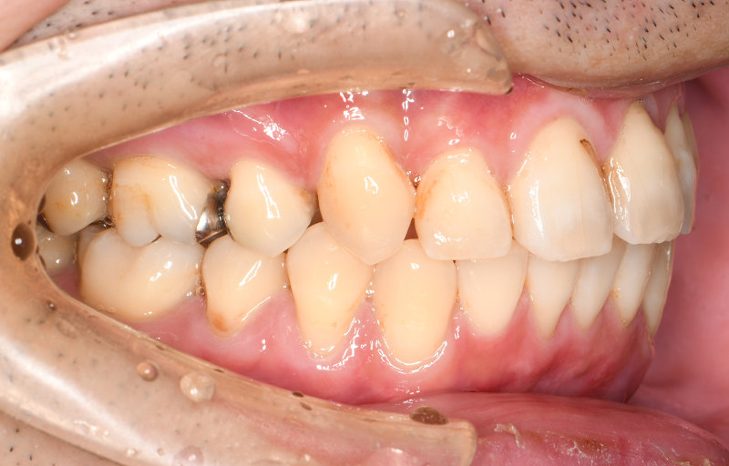 治療例016 - 左横から見た治療後の歯並び