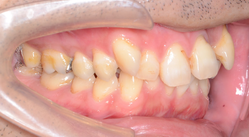 治療例016 - 左横から見た治療前の歯並び