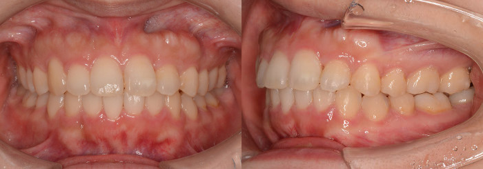 治療例017 - 治療後の歯並び