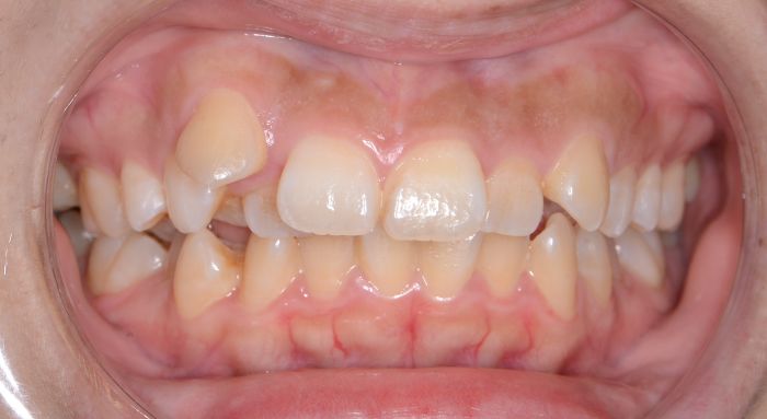 治療例018 - 正面から見た治療前の歯並び