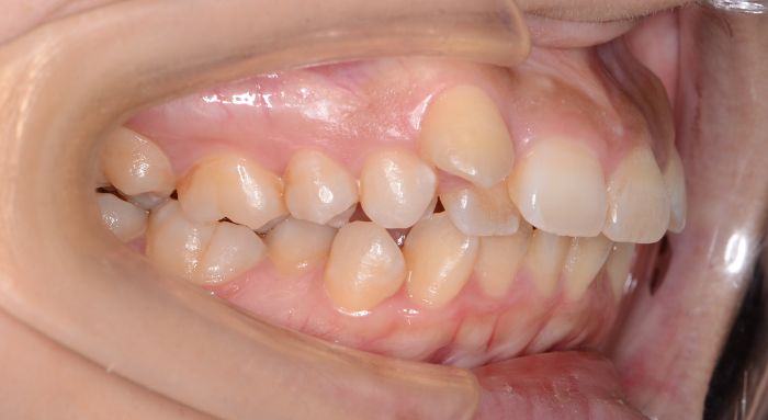 治療例018 - 左横から見た治療前の歯並び