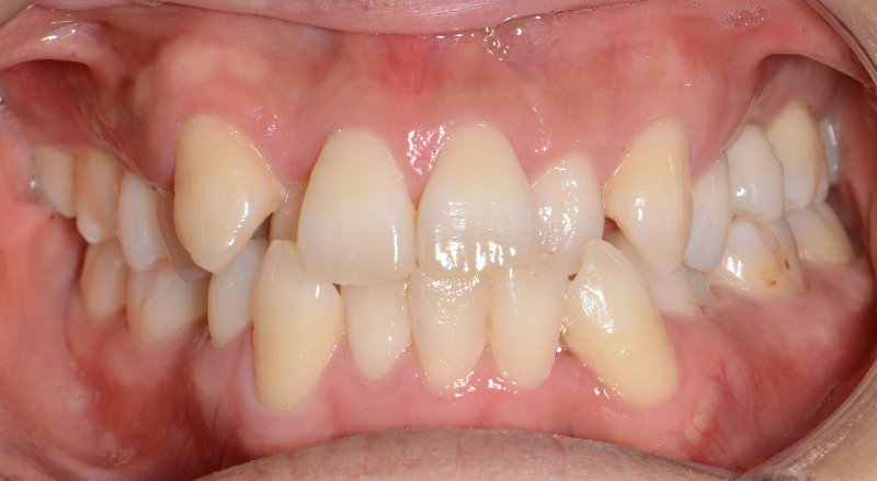 治療例019 - 正面から見た治療前の歯並び