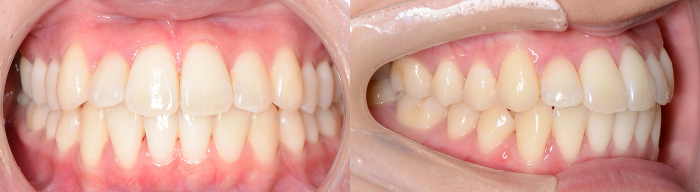 治療例020 - 治療後の歯並び