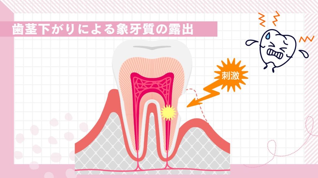 歯茎下がりによる象牙質の露出のイメージ図。