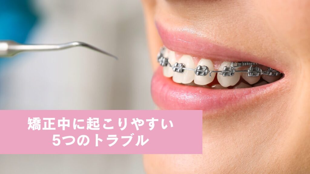 ブラケット矯正中の人の口元。“矯正中に起こりやすい5つのトラブル”