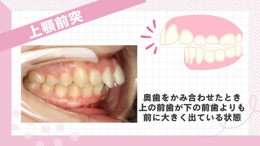 上顎前突　奥歯をかみ合わせたとき上の前歯が下の前歯よりも前に大きく出ている状態