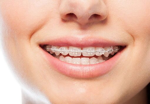 ワイヤー矯正の口元