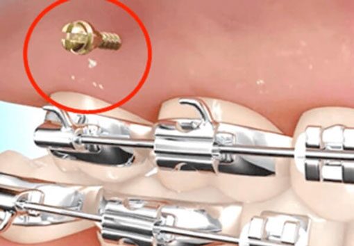 矯正用インプラントのイメージ。