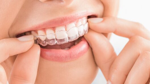 矯正マウスピースをはめようとしている人物の口もと。