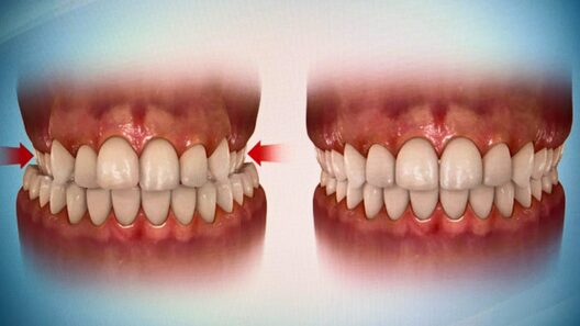 MSE（上顎拡大装置）の効果。