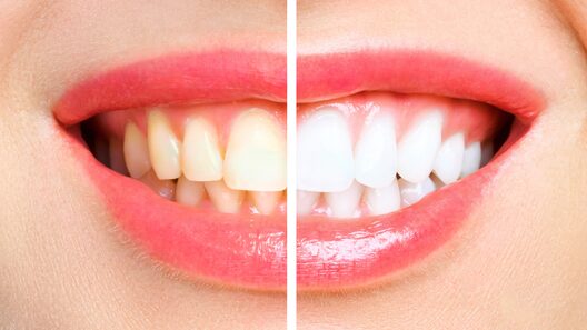 ホワイトニング前後の歯の色比較　白く美しい歯のビフォーアフター。