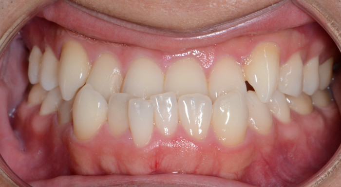 口ゴボ 受け口 梅干しジワとは コラム 公式 K Braces矯正歯科原宿駅前