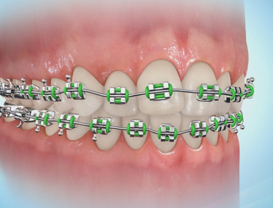 表側矯正はカラーモジュールでオシャレにできます コラム 公式 K Braces矯正歯科原宿駅前