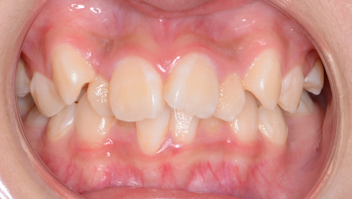 症例 重度の歯の凸凹 叢生 と八重歯の治療例 コラム 公式 K Braces矯正歯科原宿駅前