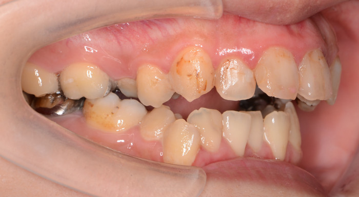 症例 重症度の高い矯正治療例 重度の下顎後退症 開咬 コラム 公式 K Braces矯正歯科原宿駅前