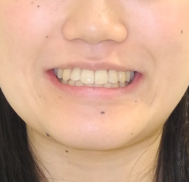 症例 歯の凸凹 叢生 と八重歯の非抜歯での矯正治療例 コラム 公式 K Braces矯正歯科原宿駅前