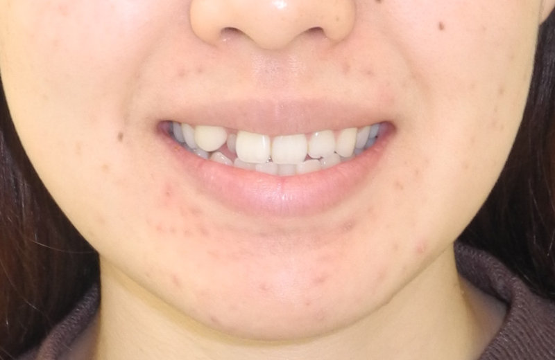 顔面左右非対称と八重歯等の裏側矯正治療例の治療前の顔貌写真