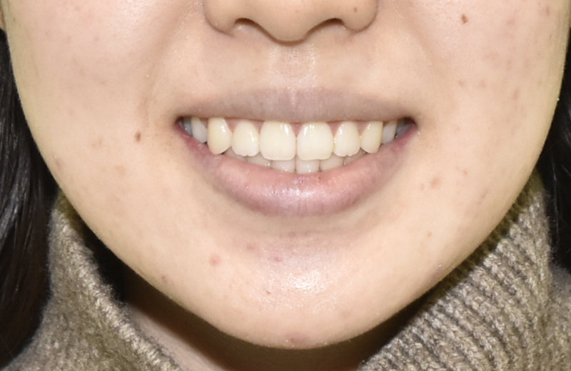 顔面左右非対称と八重歯等の裏側矯正治療例の治療後の顔貌写真