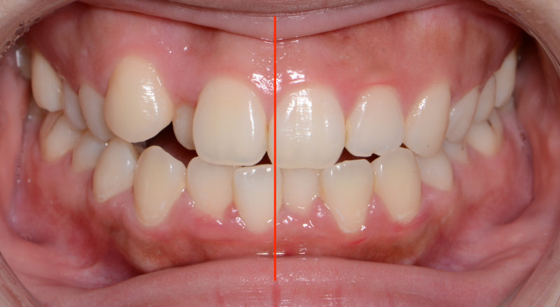 顔面左右非対称と八重歯等の裏側矯正治療例の治療前の正中を記した写真