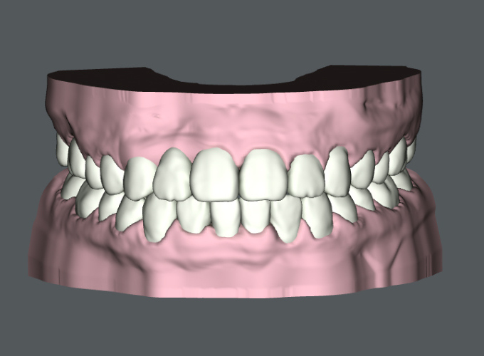 顔面左右非対称と八重歯等の裏側矯正治療例の治療後の3Dモデル写真