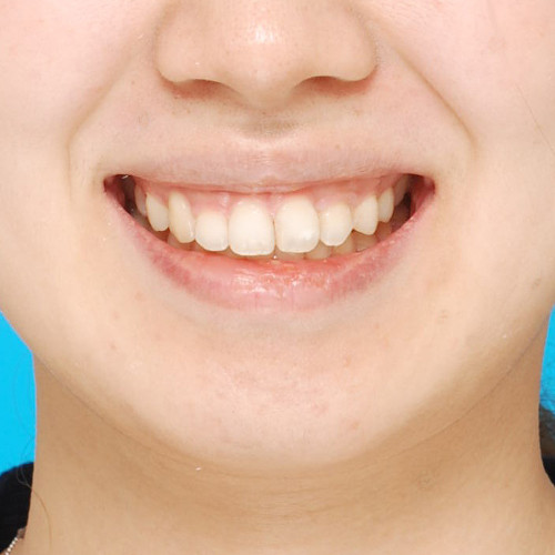 症例 歯の凸凹 叢生 と八重歯の犬歯を抜歯しての矯正治療例 コラム 公式 K Braces矯正歯科原宿駅前
