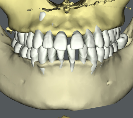 重度の歯肉退縮を伴う すきっ歯 空隙歯列 の治療例 コラム 公式 K Braces矯正歯科原宿駅前